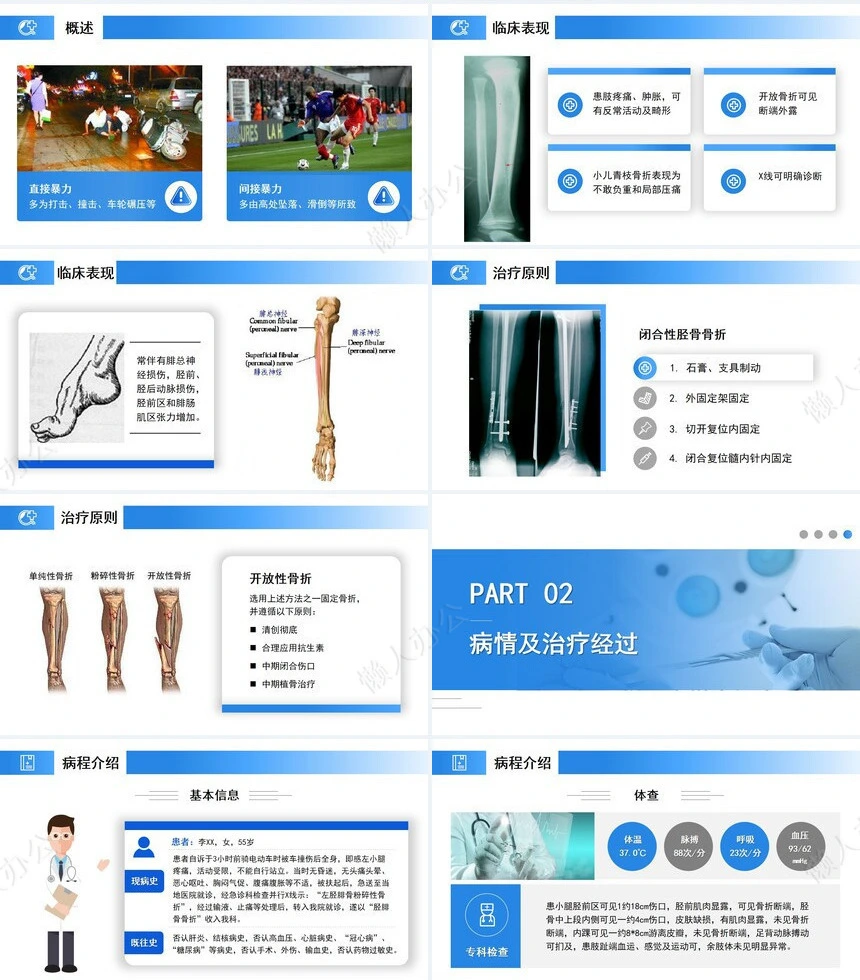 蓝色医疗模板-胫腓骨骨折护理